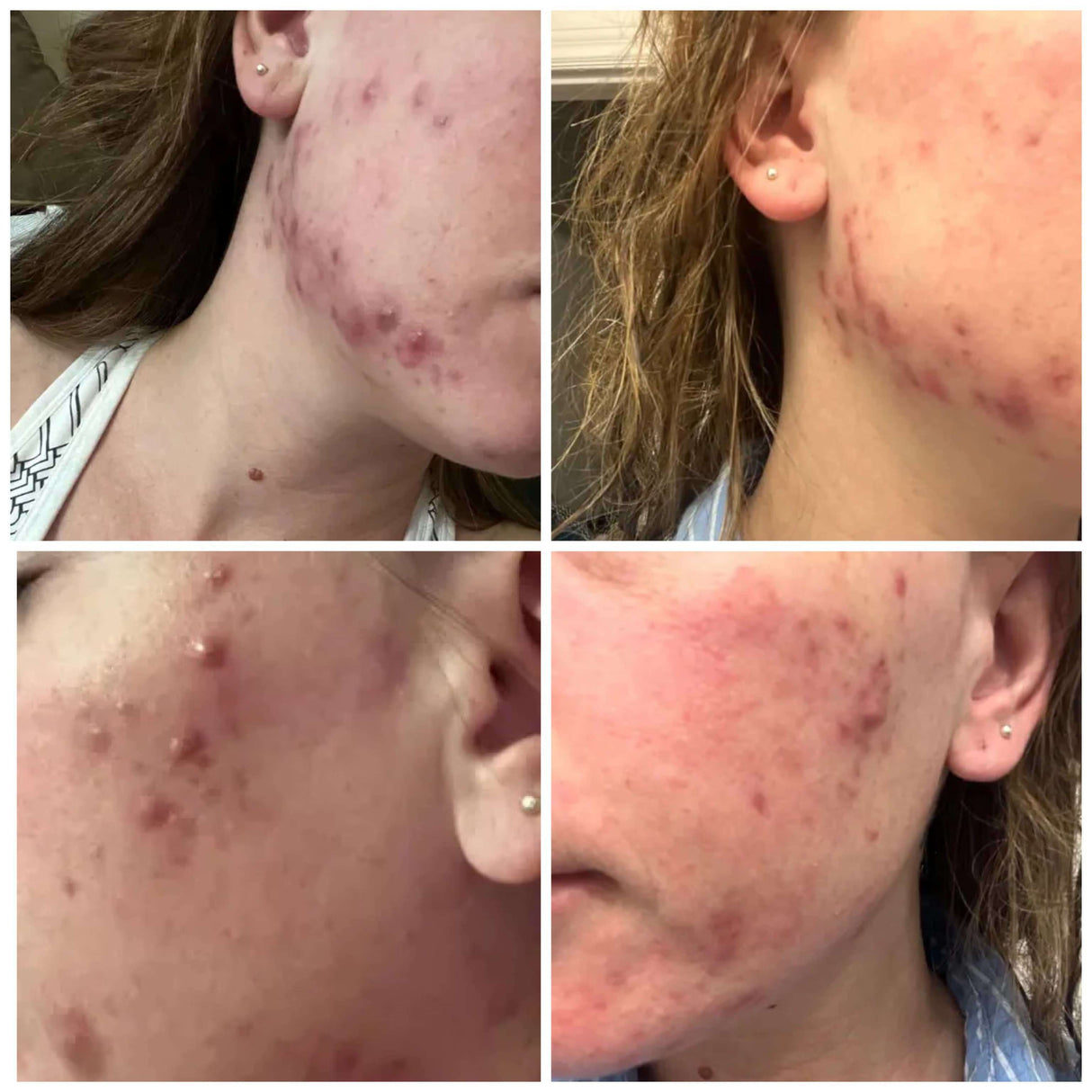 Rehab Serum: Pregnancy Acne Treatment - HoneyBug