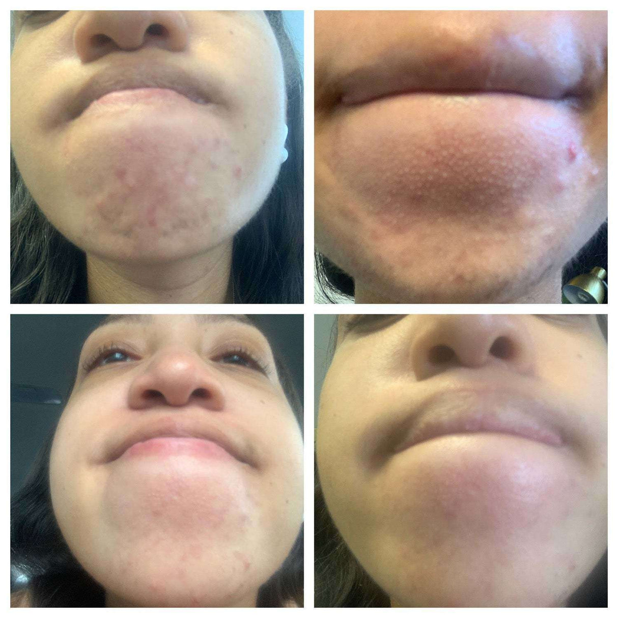 BalanC Toner - Bright Clear Skin | Pregnancy-safe Acne Toner