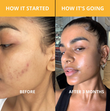 Turmeric Kojic Acid Soap - Face and Body - HoneyBug 